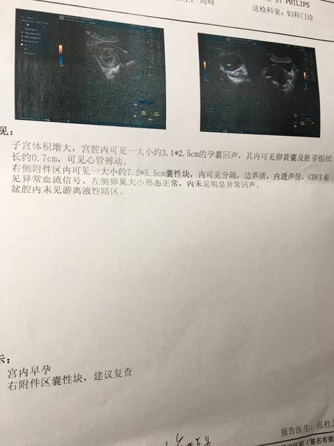 怀孕拍了胸片_在不知道自己怀孕了的情况下拍