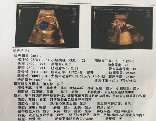 三维彩超正常,顺利_三维彩超一切正常,小心脏