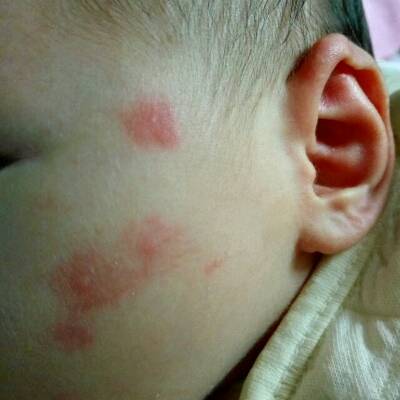 宝宝快一个月了,脸上被蚊子咬后出现了红红的