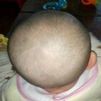 宝宝头顶有个小小地疙瘩,不动,不疼,好像还有分