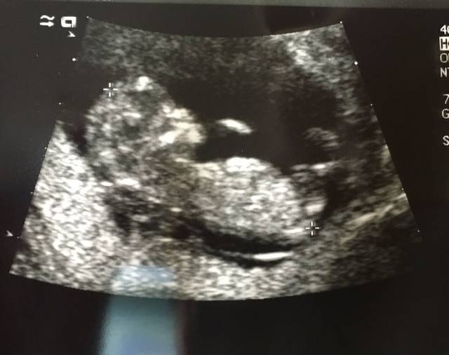 NT归来,宝宝超活跃!_上海大医院做NT真的超不