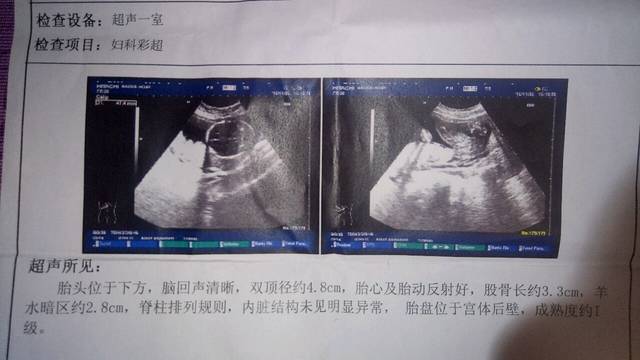 胎儿四个半月住了新房半个月对胎儿有影响