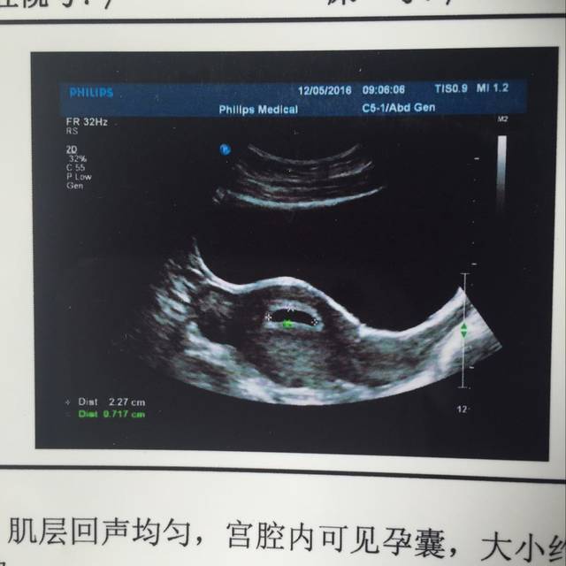 乎的胎心胎芽,附详细早孕反应。_今天7周2天,
