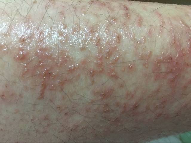 孕期痒疹_有准妈妈受同样的困扰吗?我是腿上