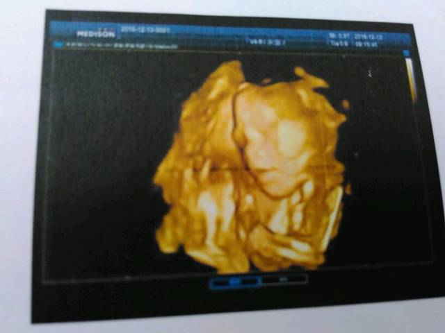 24周+胎儿超声检查报告能看出男女宝嘛?胎儿