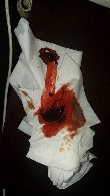 孕8周大出血_12月15号做的彩超见胎心,17号坐