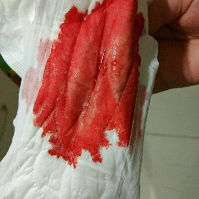 姨妈血鲜红稀薄,和以前不一样,请问是什么原因
