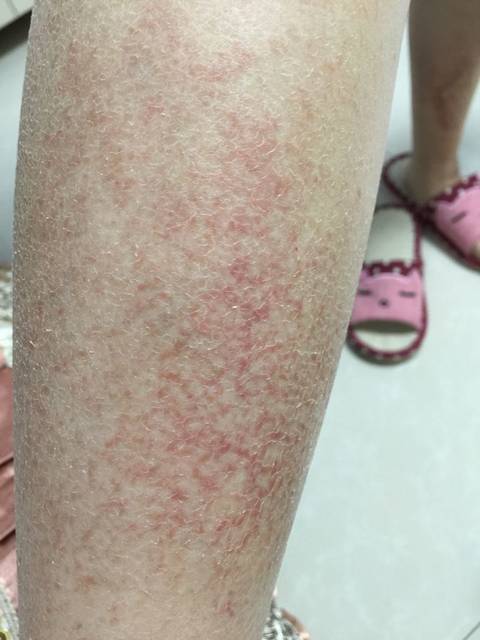 怀孕8个月起 疹子了怎么办 急求。。。_前段时间小腿起小疙瘩_宝宝树