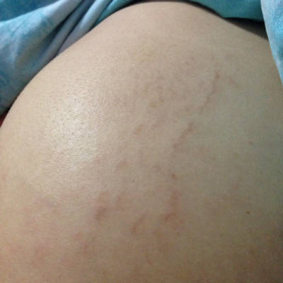请问这是不是就是妊娠纹呀!长在屁股上的