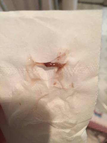 37周流宫颈黏液