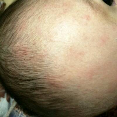 宝宝七个月了头上长很多红点,白天看到不多也