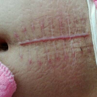 剖腹产快一个月了伤口发炎,该怎么办
