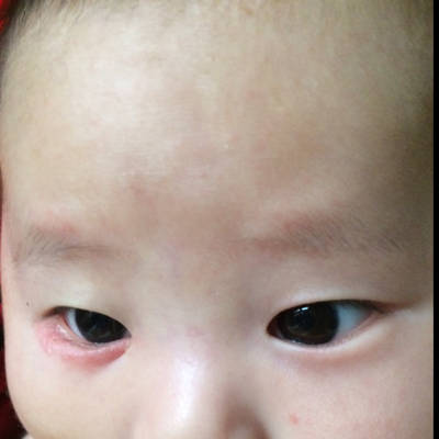宝宝四个月,最近总是用手抓眼睛,右眼下面有一
