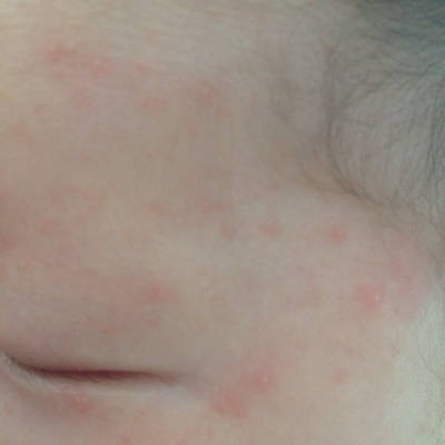 宝宝二十多天脸上长咯很多红色中间白色的小颗粒