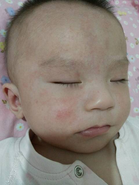 我家宝宝的脸反反复复不好怎么办 真上火 求帮