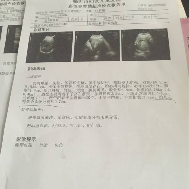 胎儿左肾集合系统分离约0.7cm_胎儿左肾集合