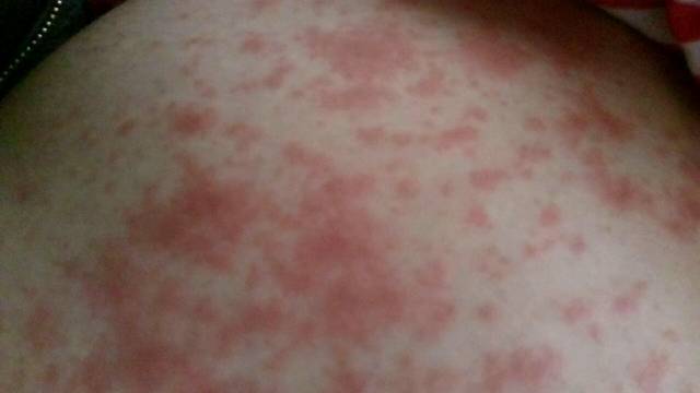 求大神帮忙解答怀孕后期身上痒的受不了_怀孕