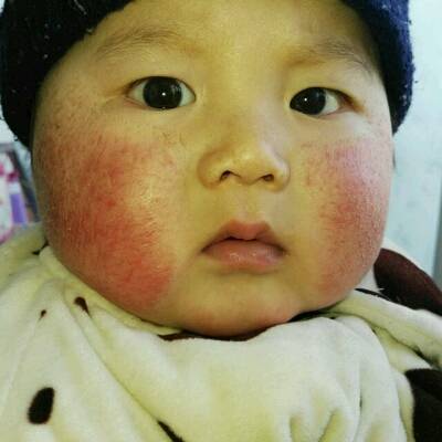 男宝宝七个多月了,脸部不知是湿疹还是过敏,整