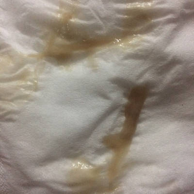 孕7周2天,有月经末褐色分泌物,休息后又有,白带