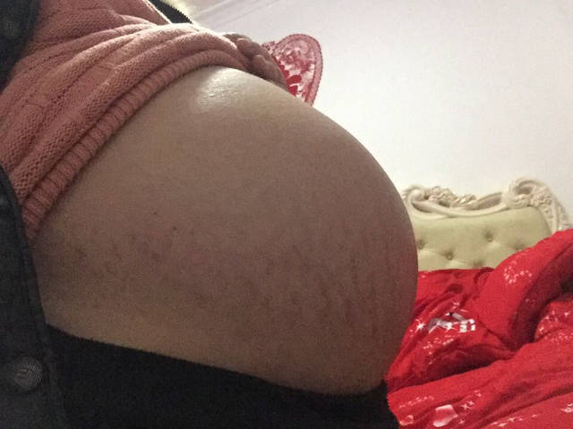 孕35周肚子好痒_怀孕35周了下腹部长了好多妊娠纹，有妊娠纹_宝宝树
