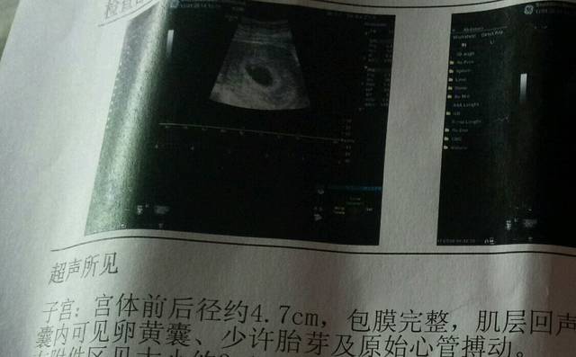 47天第一次产检_2016.12.04首次月经,2017.1