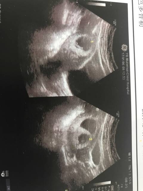 异卵双胞胎的妈妈来晒下照片…看看龙凤胎多不