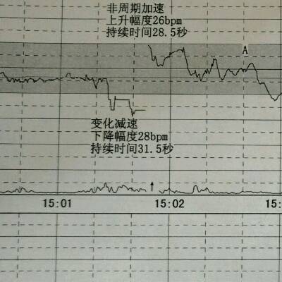 孕38周,昨天去产检,做的胎监图上峰波有变化减速,医生让我今天去复查