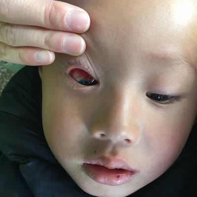 2岁半的男宝宝发烧后眼球有血块