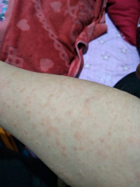 求解答_有孕期长湿疹的嘛?怎么解决的呢?_宝