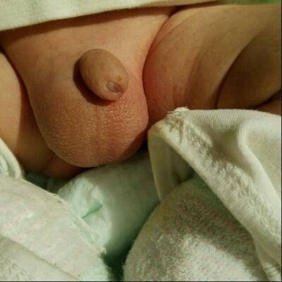 宝妈们宝宝这是鞘膜积液吗