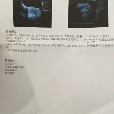 孕6周,二胎,先兆流产,右侧卵巢囊肿,肿物探及环