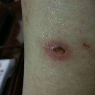 最近皮肤很不好,大块的伤口不知是什么时候起