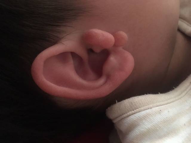 有宝宝做过附耳手术的宝妈吗