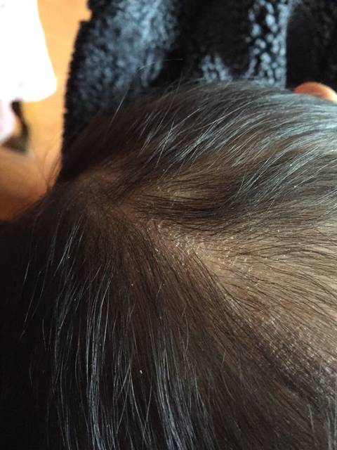 1周岁宝宝头皮干燥起皮怎么回事