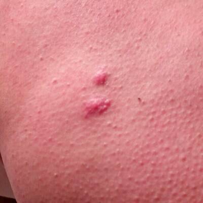 最近身上长了好多疹子,特别痒,有的人说是胎毒