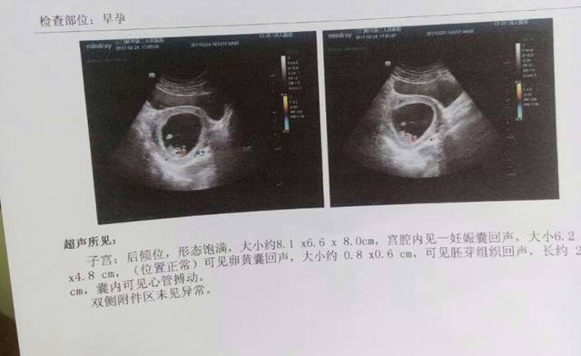 看孕囊值_二胎怀孕已经11周了,帮看看孕囊值是