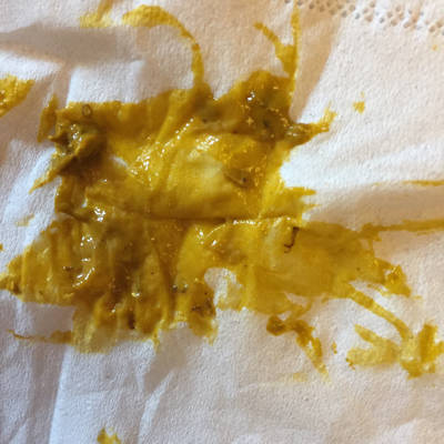 六个半月吃的大米稀饭拉的这是什么,去医院查