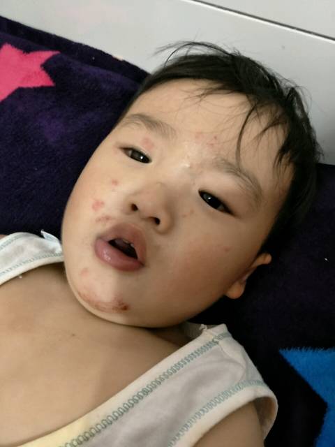 谁宝宝湿疹去温州儿童医院和上海医院看过?