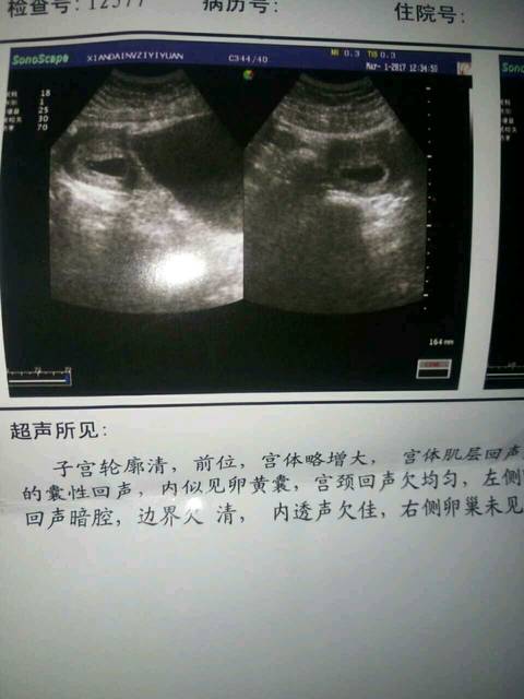 果真生了个女儿,这胎45天查的,是茄子状的胎囊,希望是个男宝宝