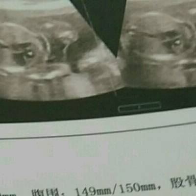 双胞胎二十一周四天,四维显示一胎儿房间隔上