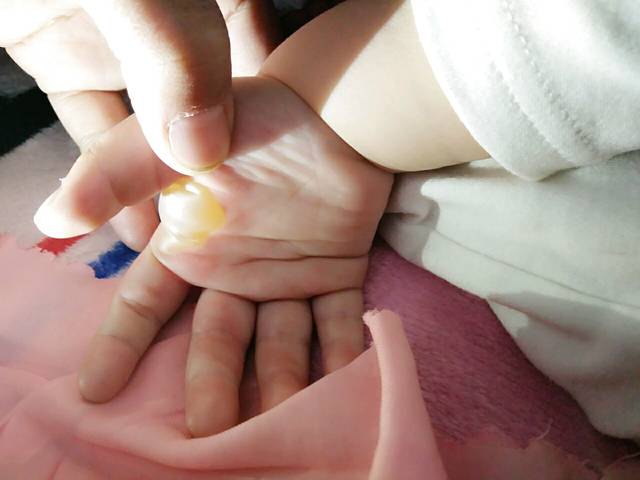 孩子烫伤起泡了,咋办? !