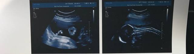 每次b超,宝宝都是趴着