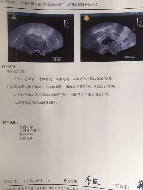 妊娠囊靠近左侧宫角是什么情况?后期还会游回