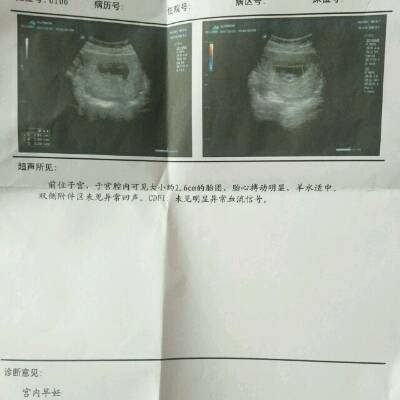 怀孕怀孕70天 有看彩超看男女的宝妈吗 看看我的是男是女 谢谢姐妹了
