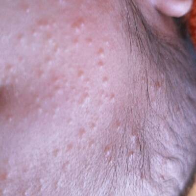 孩子脸上起一些痘痘,是过敏吗?还是病毒感染?