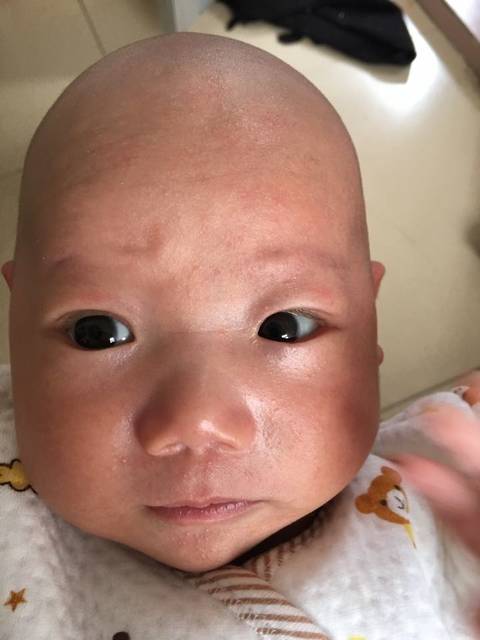 一个月宝宝脸上长满红痘痘_一个月宝宝脸上长