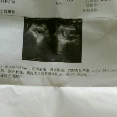 二胎怀孕7周,孕囊形态欠规则,塌陷。未见卵黄