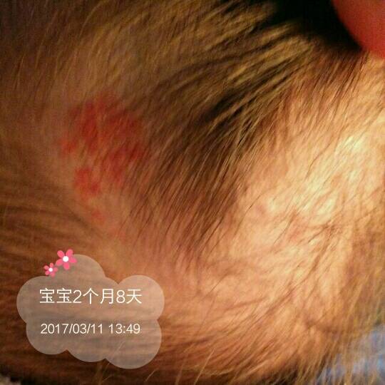 红色草莓血状管瘤_宝宝出生时头顶被挤了一块