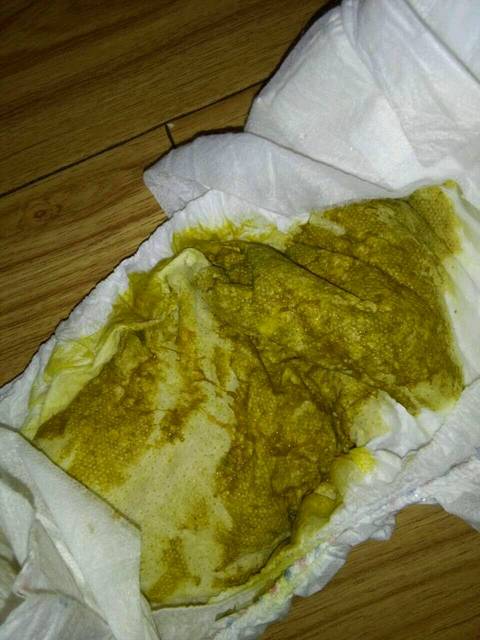 便便有血丝粘液
