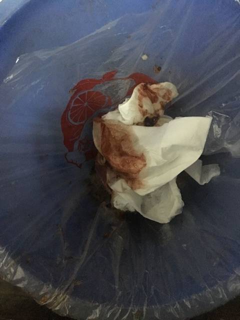 请帮忙看看_怀孕10周,孕吐厉害,晚上吐血了,怎